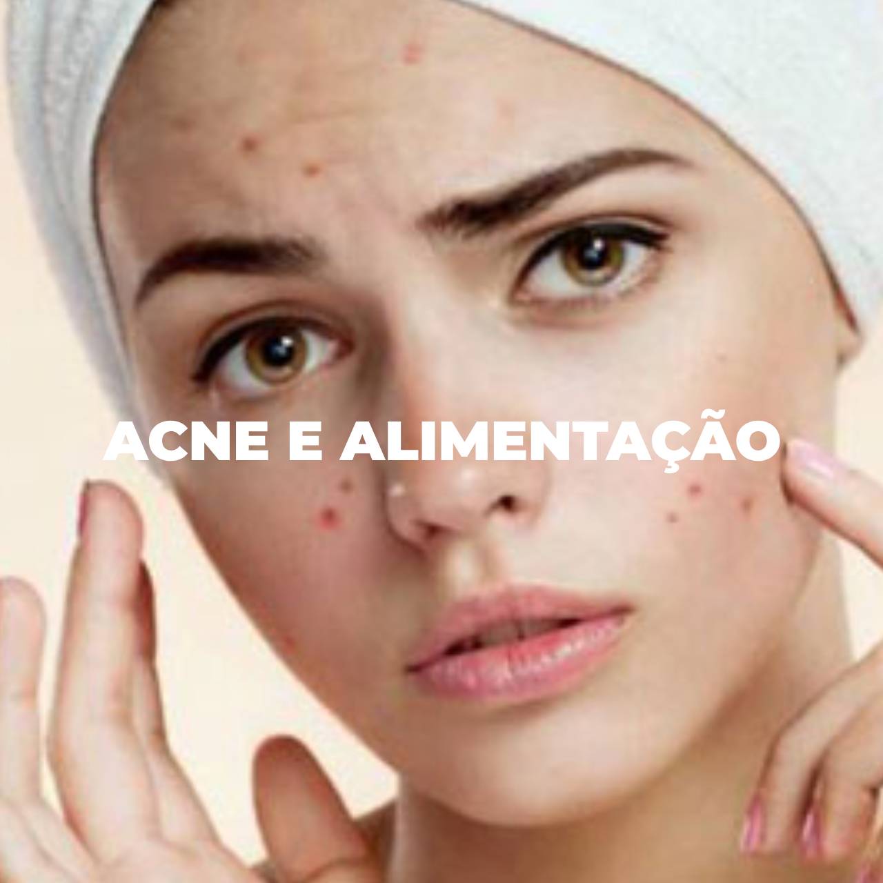 Acne e Alimentação